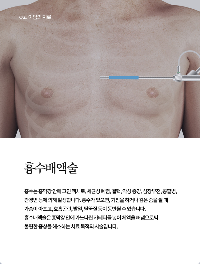 흉수배액술