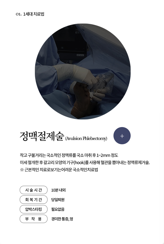 정맥절제술 (Avulsion Phlebectomy)