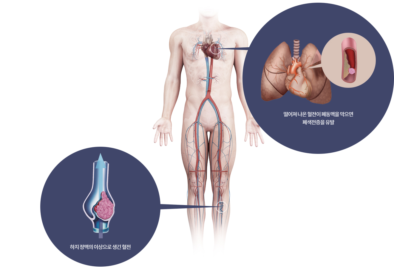 심부정맥혈전증의 원인