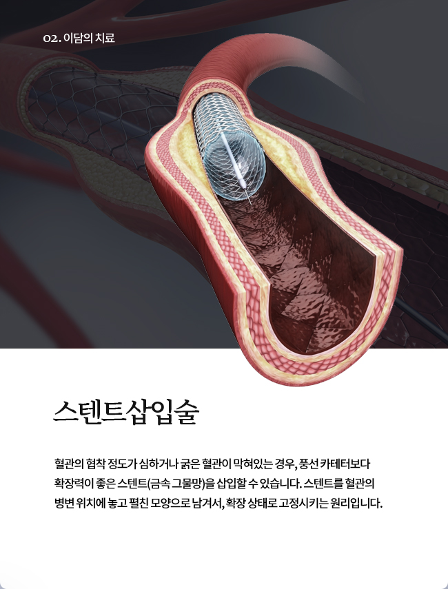 스텐트삽입술