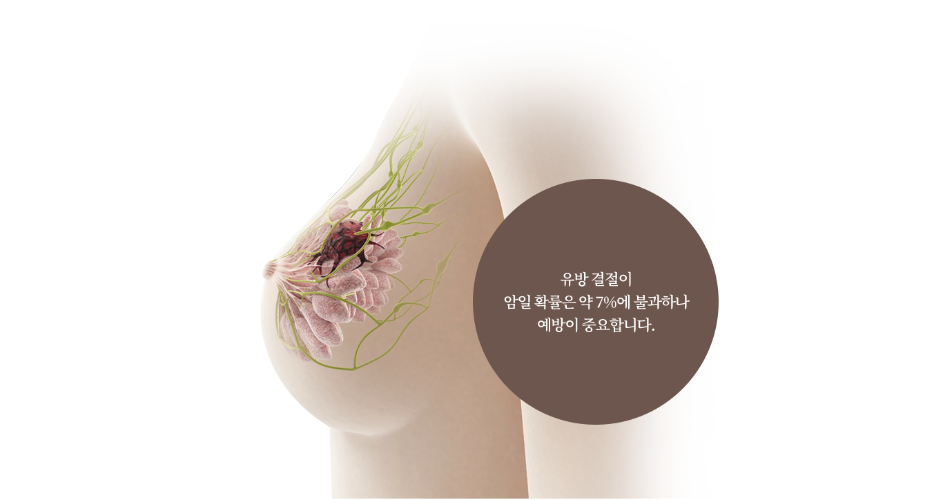 유방 결절